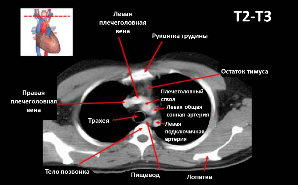 Компьютерная томография, КТ, грудная клетка, структуры грудной клетки, Компьютерная томография грудной клетки