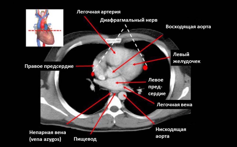 Компьютерная томография, КТ, грудная клетка, структуры грудной клетки, Компьютерная томография грудной клетки