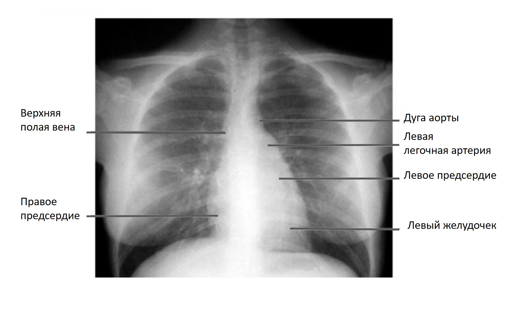 Рентгенологические границы сердца, рентгенология, Рентген, границы сердца, рентген сердца, Рентгенография органов грудной клетки, границы сердца на рентгене, определение границ сердца